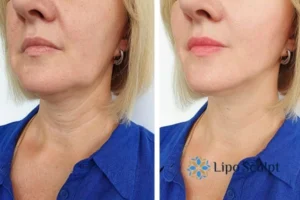 Double chin before and after Hi-Fu treatment 4 Book your double chin treatment Sutton today! We are here to help!