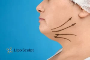 Double chin before and after Hi-Fu treatment 3 Boost your confidence with a Double chin treatment Sutton