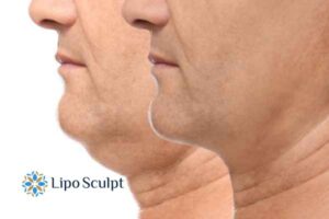Double chin before and after Hi-Fu treatment 2 Double chin treatment Sutton from Lipo Sculpt - feel more confident today!