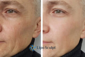 How to Fight Aging Symptoms 3 Fight Aging Symptoms Sutton With HIFU and Morpheus8 Today!