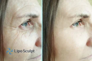 How to Fight Aging Symptoms 2 Do you want to Fight Aging Symptoms Sutton? Contact Lipo Sculpt today!