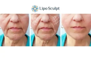 Explaining Morpheus8 And What It Can Do For You 3 Boost your confidence with Morpheus8 Sutton call our team today!