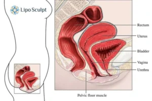 Treatment For A Leaky Bladder 2 How EM Chair treatment Sutton can help Leaky bladder issues. Read more now!