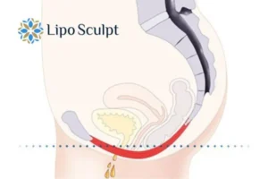 Pelvic Floor Chair Therapy 1 Pelvic Floor Chair Therapy Sutton to treat incontinence.