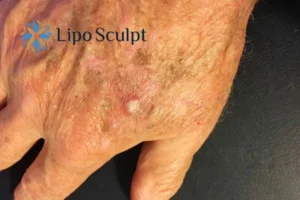 Best Actinic Keratoses Removal 2 Improve your wellbeing and health with Actinic Keratoses Sutton removal.treatment