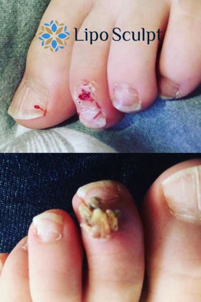 Wart removal customer results from Lipo Sculpt Sutton