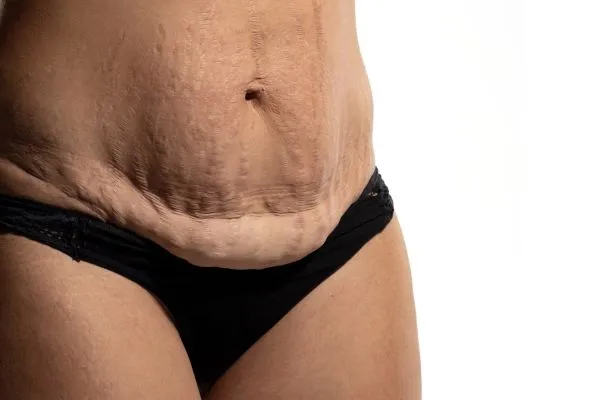 Lost the Weight but Not the Loose Skin? 1 image of womans stomach after weight loss showing loose skin Sutton